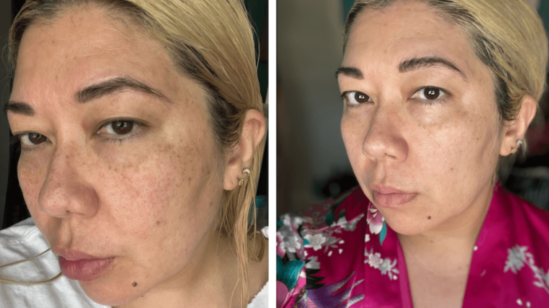  Alastin A-Luminate Brightening Serum Review After 