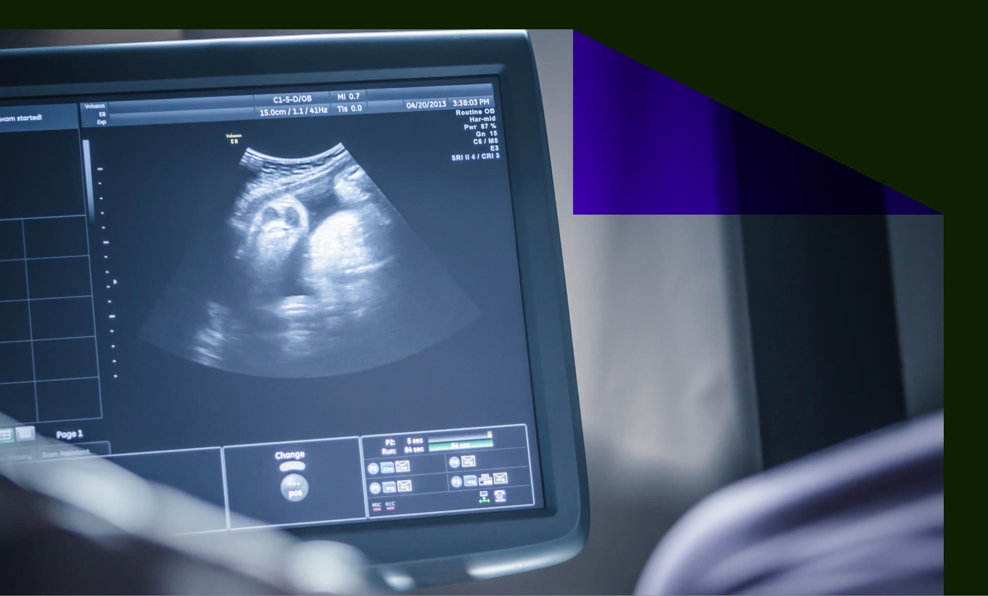 A pregnant woman having sonogram