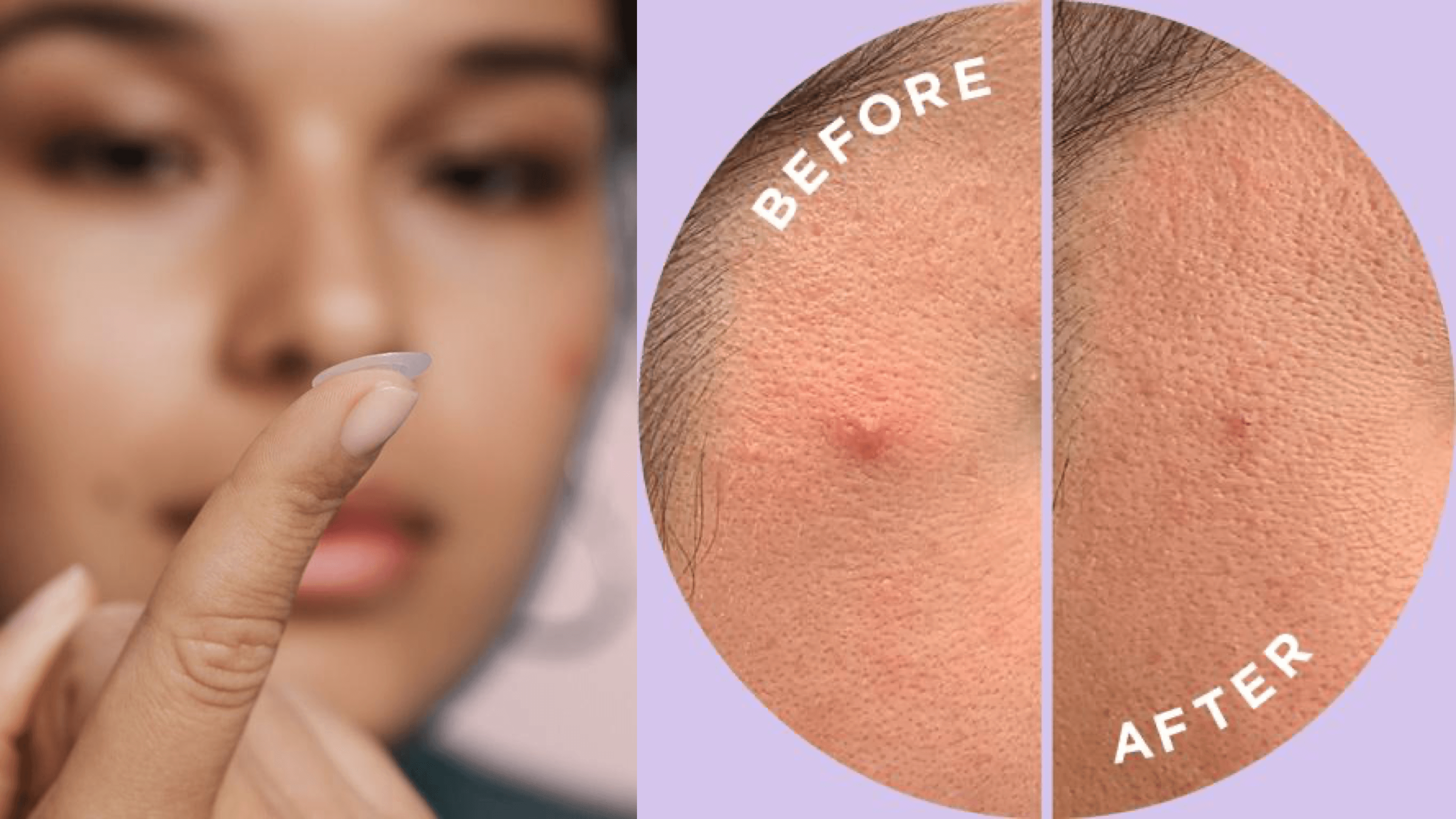 pimple patches to help heal breakouts 