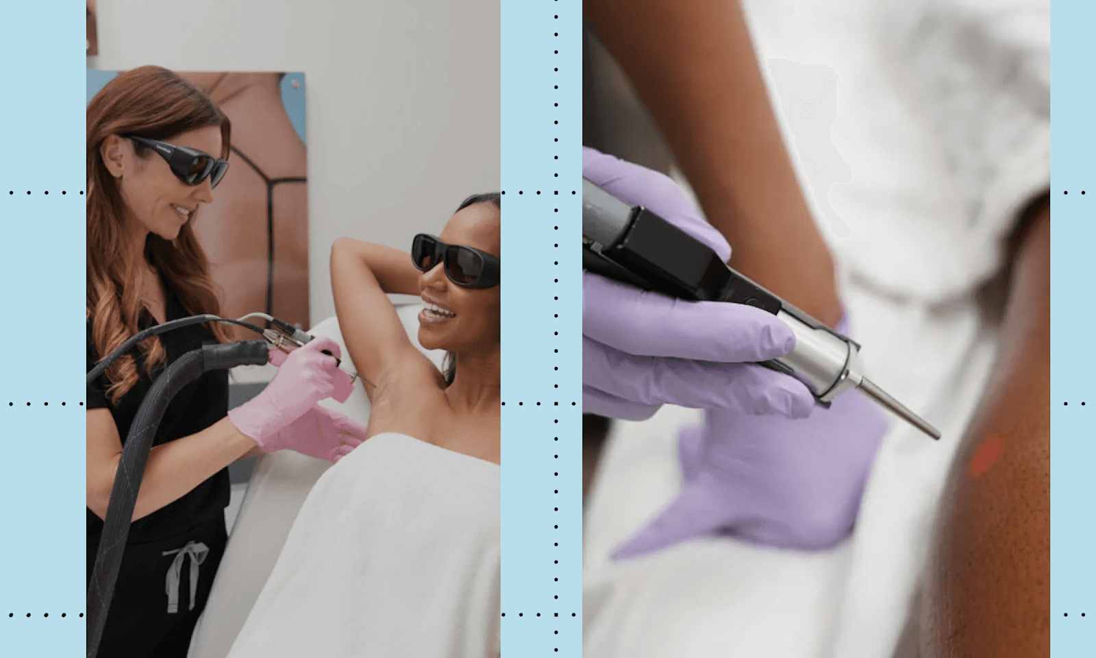 laseraway laser hair removal review