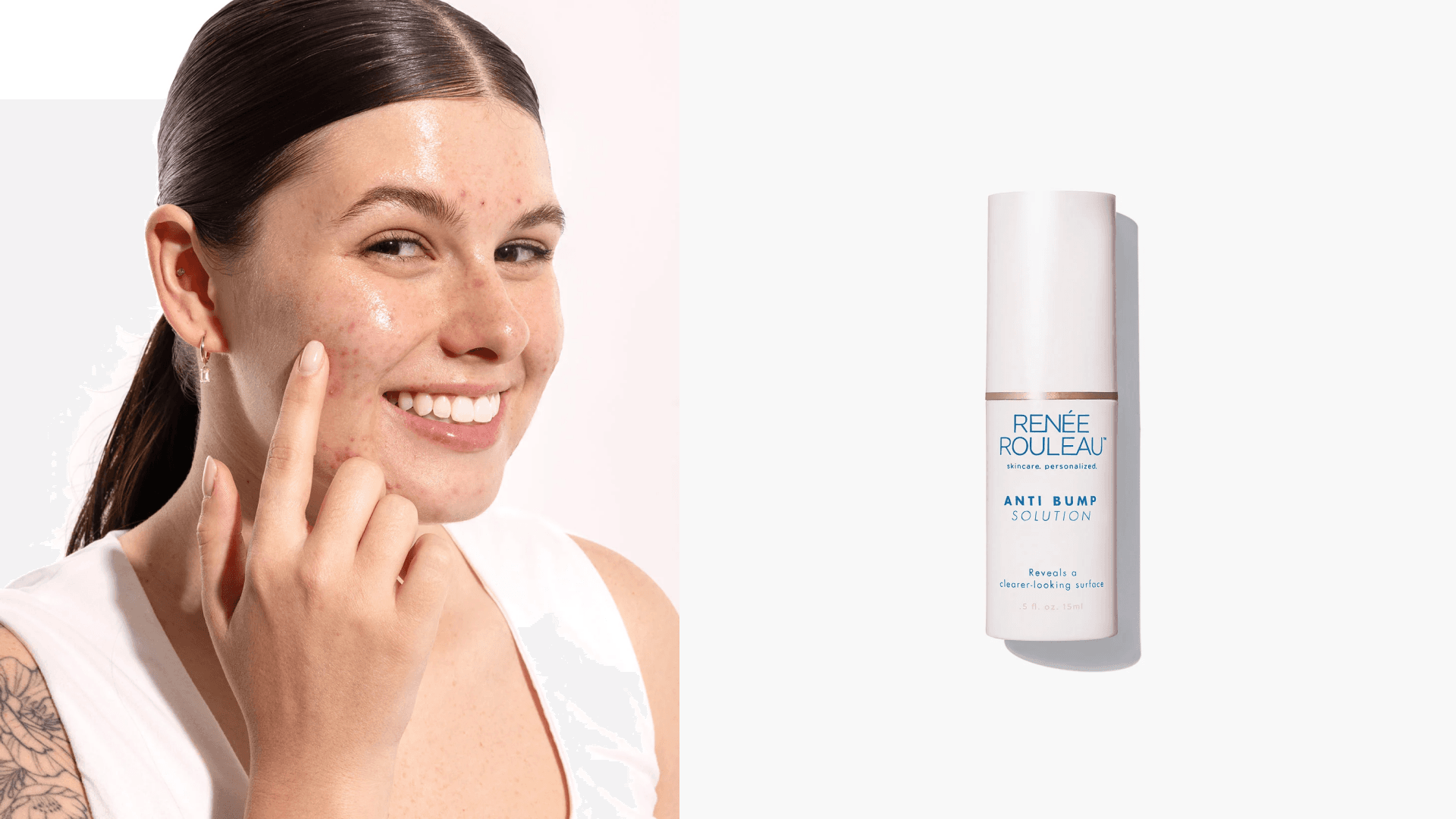acne-treatment