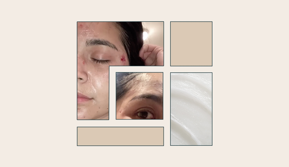 Featured image for CeraVe's $17 Healing Ointment Vanished the Facial Scars I Thought Would Never, Ever Go Away
